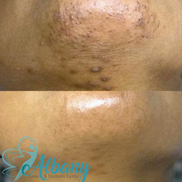 laser hair removal results