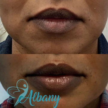 lip augmentation results