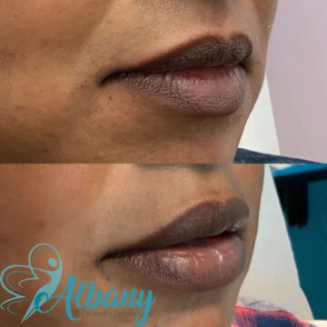 lip augmentation results