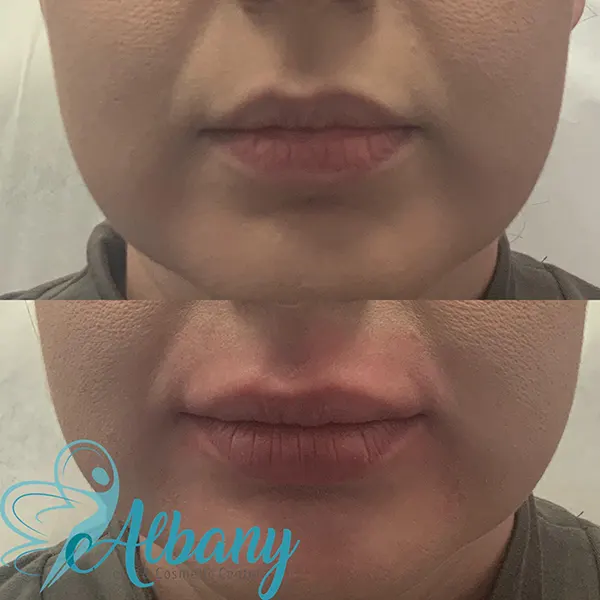lip augmentation results 2