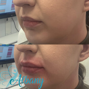 lip augmentation results