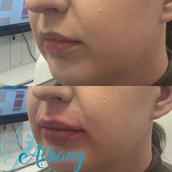 lip augmentation results