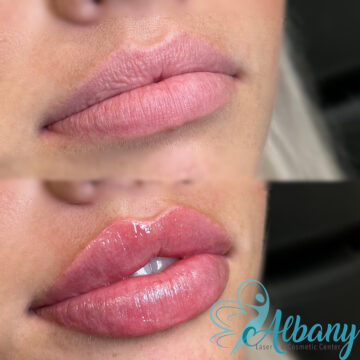 Results of Lip fillers Edmonton