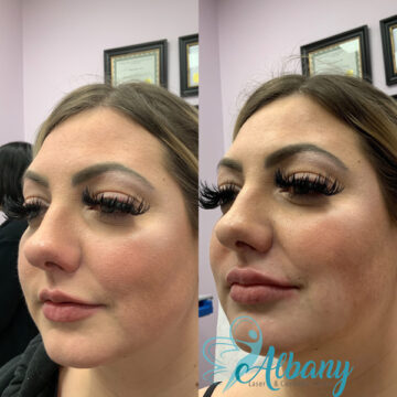 lip injections results