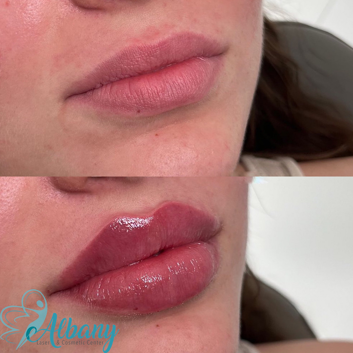 Lip injections Results Edmonton
