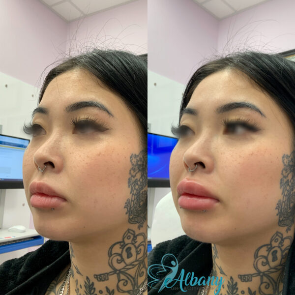 Lip fillers case