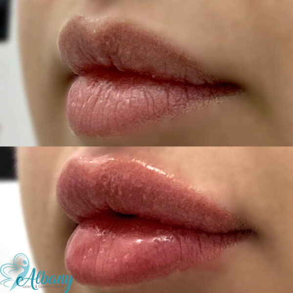 Lip fillers Edmonton