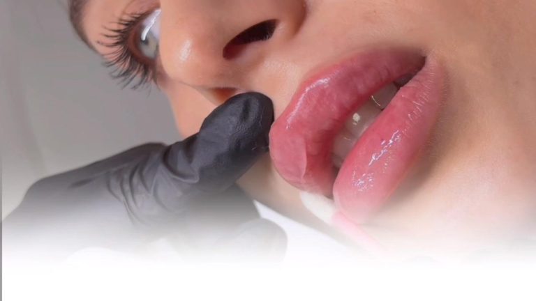 Close-up of a clinician in black gloves gently holding a client’s upper lip during a cosmetic lip procedure.