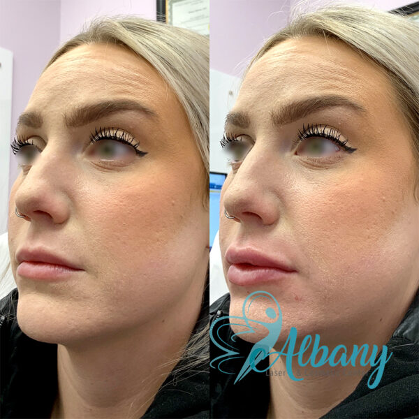 Lip injections results