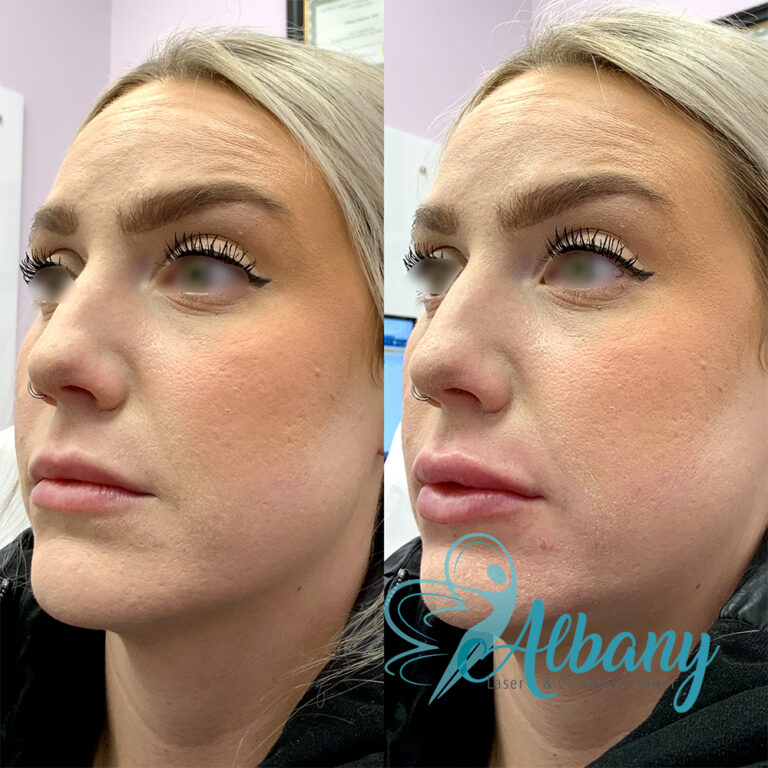 Lip injections results