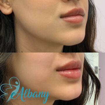 lip fillers edmonton