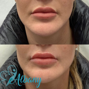 Best lip fillers edmonton