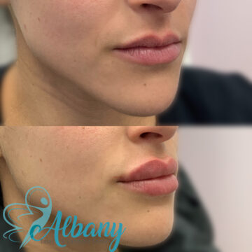 Lip fillers Edmonton