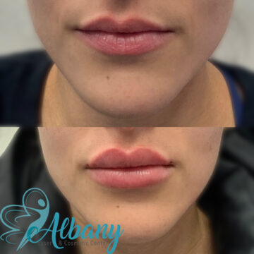 Lip fillers St. Albert