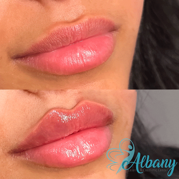 Comparison image of lips before and after lip fillers Edmonton treatment, highlighting increased volume and definition
