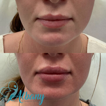 lip fillers results edmonton