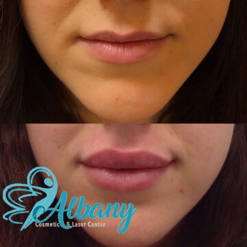 lip fillers before and after
