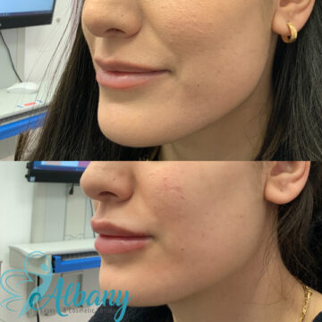 lip fillers St. Albert