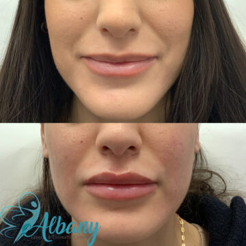 lip fillers edmonton