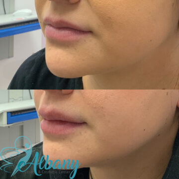 lip fillers results Edmonton