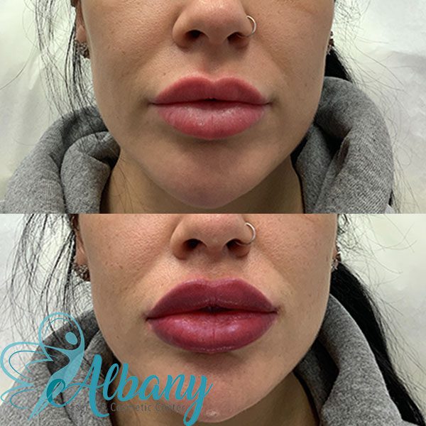 lip fillers albany laser