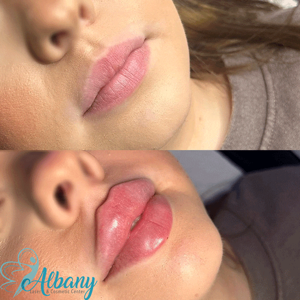 Before and after photo showing lip enhancement results from dermal fillers
