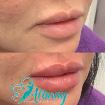 Lip injections