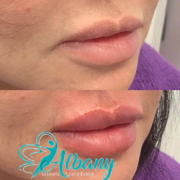Lip injections