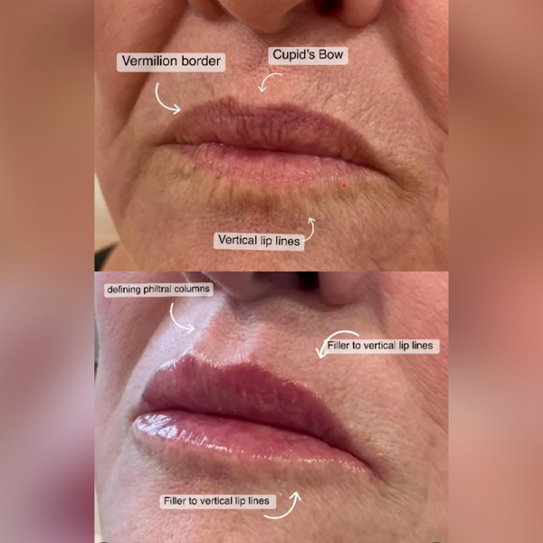 lip line treatment results at albany cosmetic and laser centre in Edmonton