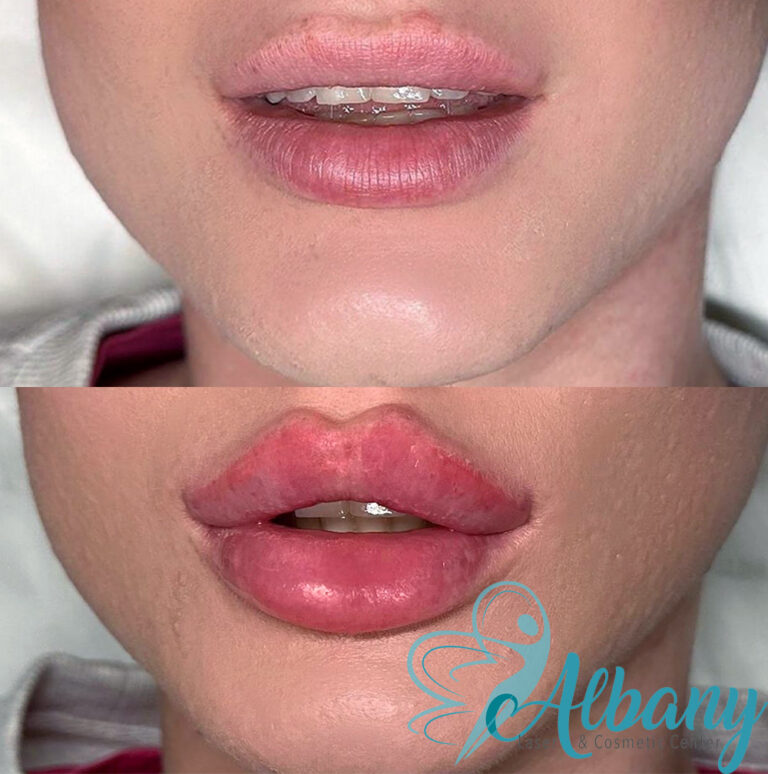 Lip injection Edmonton before and after