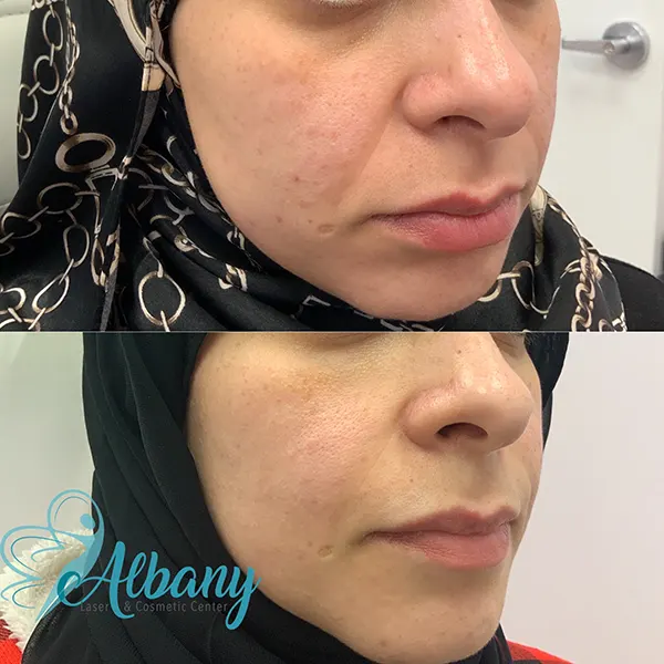 liquid facelift results in Edmonton