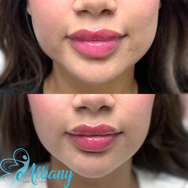 before and After Masseter Botox