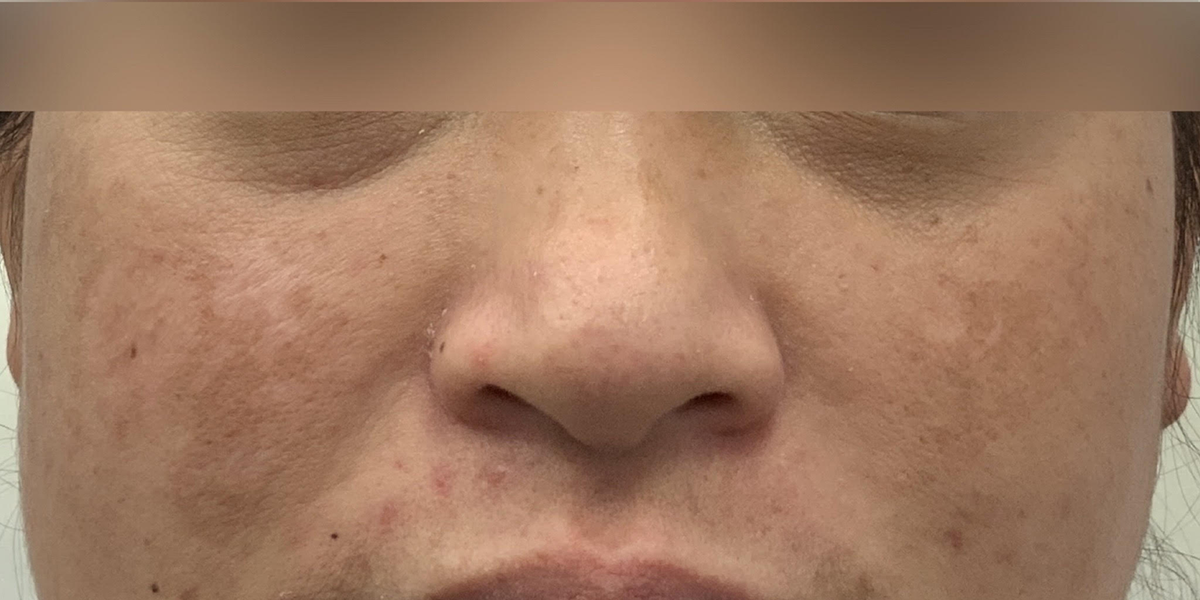 Close-Up Transformation: Melasma Treatment with Fraxel