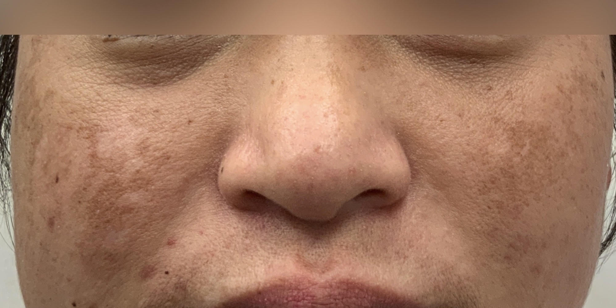 Before Melasma Treatment with Fraxel