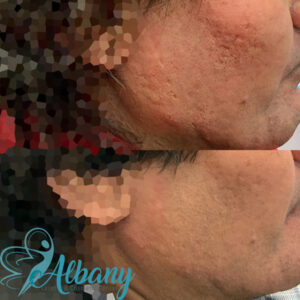 Microneedling results
