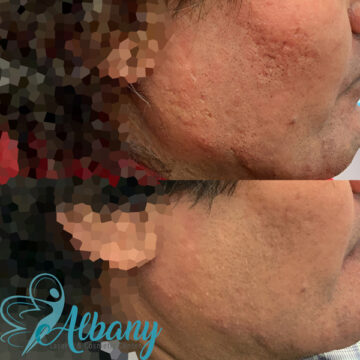 Microneedling results