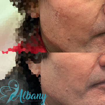 Microneedling results