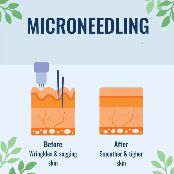microneedling infographics