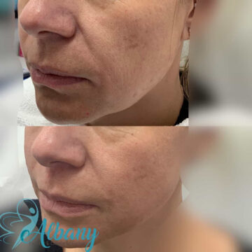facelift results