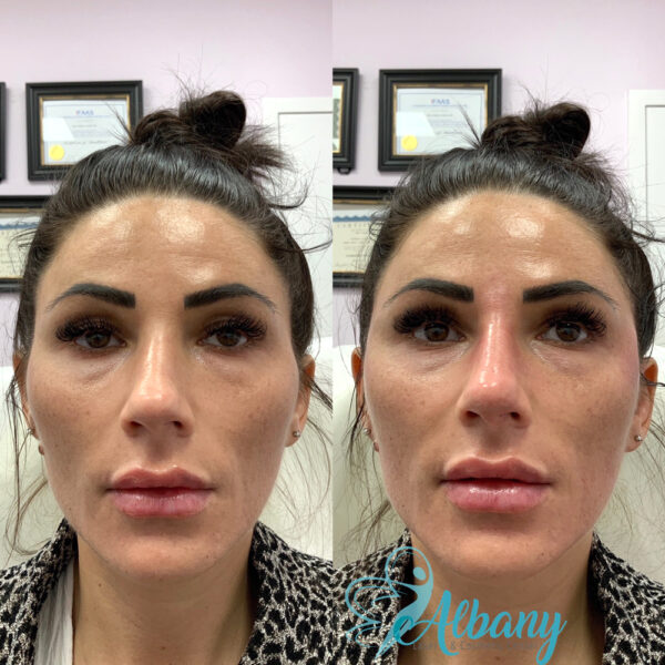 nose and temple fillers