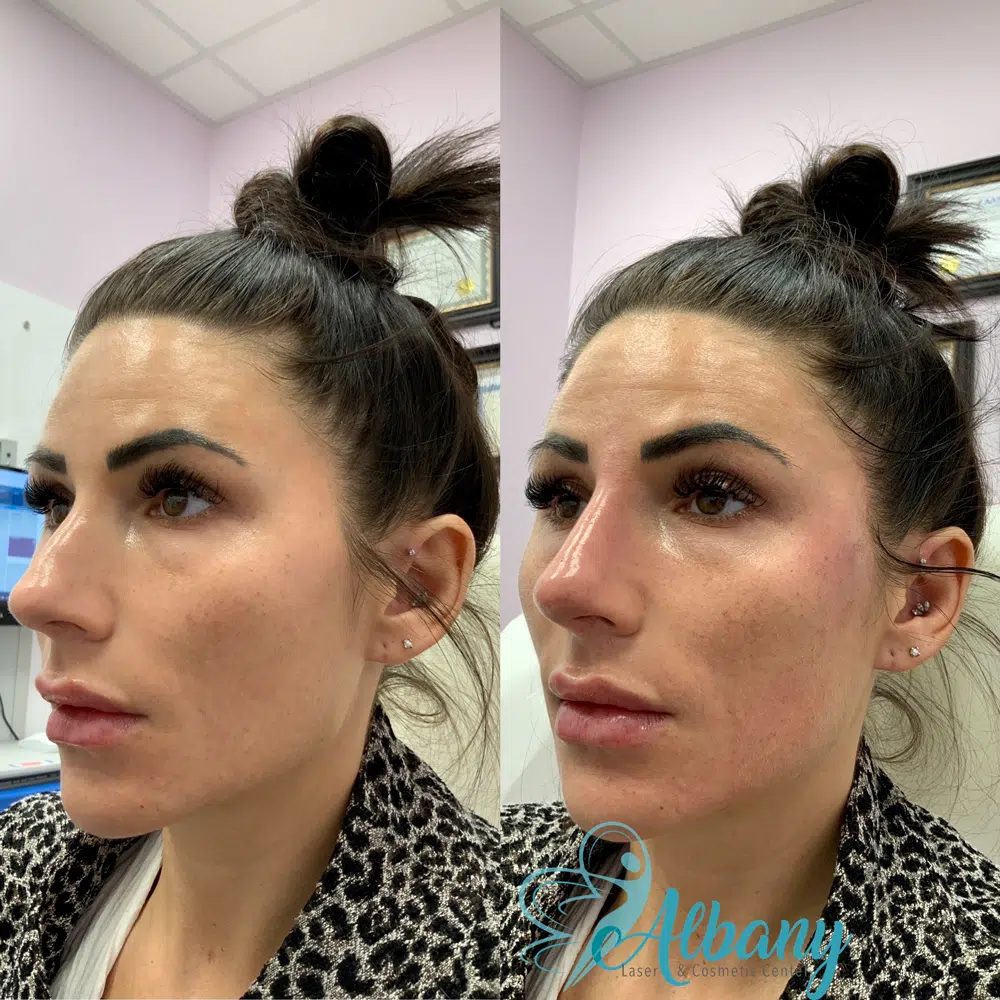 nose and temple fillers