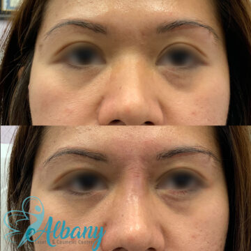 nose job edmonton