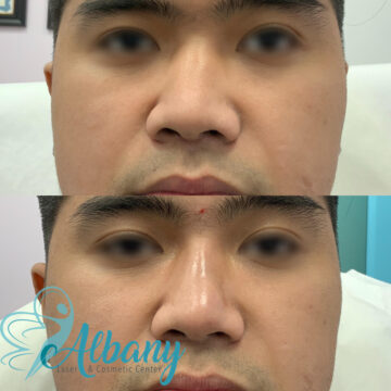 nose fillers results