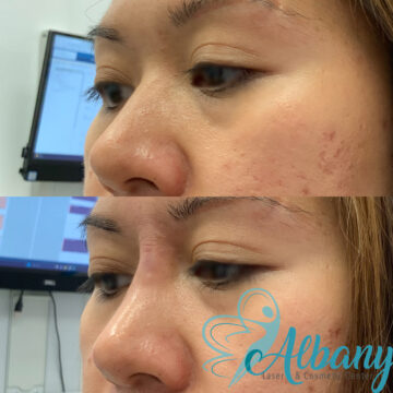 non-surgical nose job