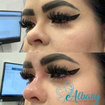 nose fillers edmonton