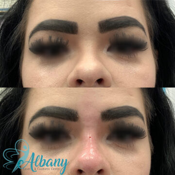 nose fillers