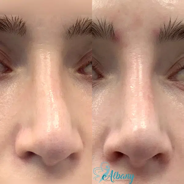 nose job results