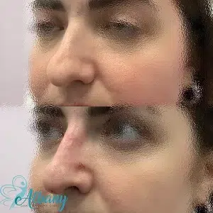 nose job results edmonton