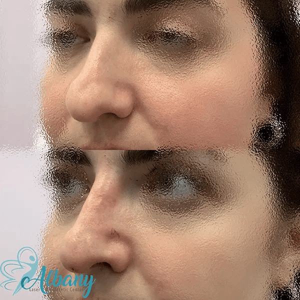 nose job results in edmonton 3