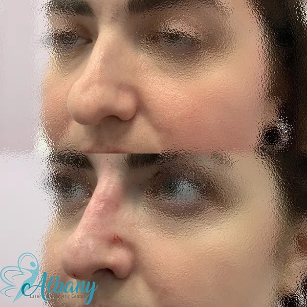Nonsurgical nose enhancement Albany Cosmetic & Laser centre